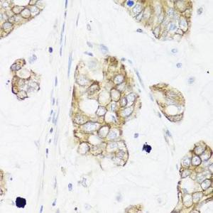 Immunohistochemistry analysis of paraffin-embedded human gastric cancer using Anti-IEX1/IER3 Antibody (A12282) at a dilution of 1:100 (40X lens). Perform microwave antigen retrieval with 10 mM PBS buffer pH 7.2 before commencing with IHC staining protocol