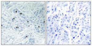 Immunohistochemical analysis of paraffin-embedded human breast cancer using Anti-MAP4K6 Antibody 1:100 (4°C overnight) The right hand panel represents a negative control, where the antibody was pre-incubated with the immunising peptide