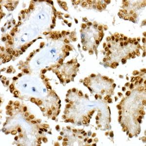 Immunohistochemistry analysis of paraffin-embedded human thyroid cancer using Anti-PAX8 Antibody [ARC55538] (A305642) at a dilution of 1:300 (40x lens) Perform high pressure antigen retrieval with 10 mM citrate buffer pH 60 before commencing with IHC staining protocol