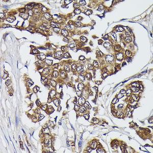 Immunohistochemistry analysis of paraffin-embedded human breast cancer tissue using Anti-Kindlin 2 Antibody (A12294) at a dilution of 1:300 (40x lens). Perform high pressure antigen retrieval with 10 mM citrate buffer pH 6.0 before commencing with IHC staining protocol.