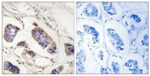 Immunohistochemical analysis of paraffin-embedded human breast carcinoma tissue using Anti-PEX7 Antibody. The right hand panel represents a negative control, where the antibody was pre-incubated with the immunising peptide