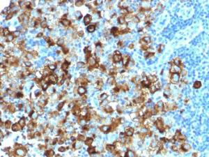 Immunohistochemical analysis of formalin-fixed, paraffin-embedded human melanoma using Anti-Melanoma gp100 Antibody [PMEL/1825R]