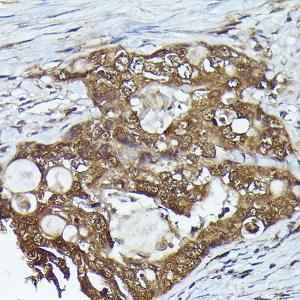 Immunohistochemistry analysis of paraffin-embedded human colon carcinoma tissue using Anti-Kindlin 2 Antibody (A12294) at a dilution of 1:300 (40x lens). Perform high pressure antigen retrieval with 10 mM citrate buffer pH 6.0 before commencing with IHC staining protocol.