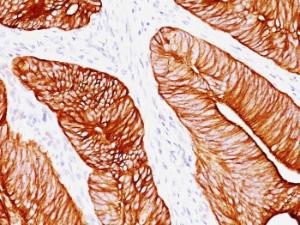 Immunohistochemical analysis of formalin-fixed, paraffin-embedded human colon carcinoma using Anti-Cytokeratin 8 Antibody [K8.8]