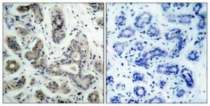 Immunohistochemical analysis of paraffin-embedded human breast carcinoma tissue using Anti-PDK1 Antibody. The right hand panel represents a negative control, where the antibody was pre-incubated with the immunising peptide