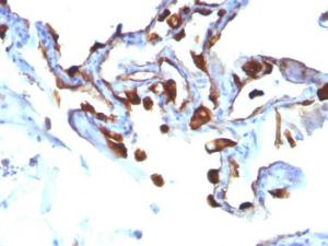 Immunohistochemical analysis of formalin-fixed, paraffin-embedded human lung carcinoma using Anti-Cytokeratin 8 Antibody [KRT8/803]