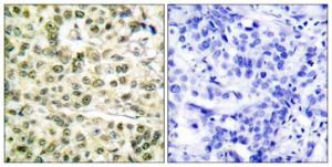 Immunohistochemical analysis of paraffin-embedded human breast carcinoma tissue using Anti-PCNA Antibody. The right hand panel represents a negative control, where the antibody was pre-incubated with the immunising peptide