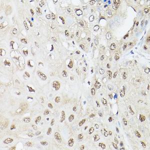 Immunohistochemistry analysis of paraffin-embedded human esophageal cancer using Anti-UBQLN2 Antibody (A12376) at a dilution of 1:200 (40x lens) Perform high pressure antigen retrieval with 10 mM citrate buffer pH 60 before commencing with IHC staining protocol