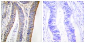 Immunohistochemical analysis of paraffin-embedded human colon carcinoma using Anti-p47 phox (phospho Ser359) Antibody. The right hand panel represents a negative control, where the antibody was pre-incubated with the immunising peptide.