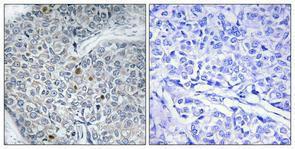 Immunohistochemical analysis of paraffin-embedded human breast cancer using Anti-HOXD12 Antibody 1:100 (4 °C overnight). The right hand panel represents a negative control, where the Antibody was pre-incubated with the immunising peptide