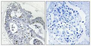 Immunohistochemical analysis of paraffin-embedded human breast cancer using Anti-HOXD12 Antibody 1:100 (4 °C overnight). The right hand panel represents a negative control, where the Antibody was pre-incubated with the immunising peptide