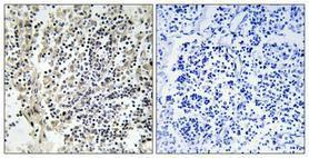 Immunohistochemical analysis of paraffin-embedded human lung cancer using Anti-p47 phox (phospho Ser359) Antibody 1:100 (4°C overnight). The right hand panel represents a negative control, where the antibody was pre-incubated with the immunising peptide.