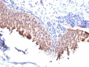 Immunohistochemical analysis of formalin-fixed, paraffin-embedded human bladder carcinoma using Anti-Cytokeratin 10 Antibody [SPM261]