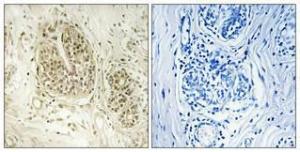 Immunohistochemical analysis of paraffin-embedded human breast cancer using Anti-NOC2L Antibody 1:100 (4°C overnight) The right hand panel represents a negative control, where the antibody was pre-incubated with the immunising peptide