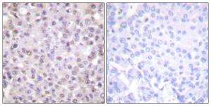 Immunohistochemical analysis of paraffin-embedded human breast carcinoma tissue using Anti-NCoR1 Antibody. The right hand panel represents a negative control, where the antibody was pre-incubated with the immunising peptide