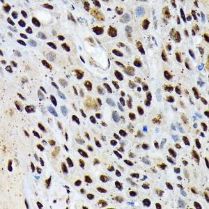 Immunohistochemistry analysis of paraffin-embedded human esophageal cancer using Anti-ENT2 Antibody [ARC2234] (A306994) at a dilution of 1:100 (40x lens). Perform microwave antigen retrieval with 10 mM Tris/EDTA buffer pH 9.0 before commencing with IHC staining protocol.