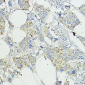 Immunohistochemistry analysis of paraffin-embedded human mammary cancer using Anti-SOCS6 Antibody (A12430) at a dilution of 1:100 (40x lens)