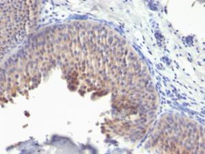 Immunohistochemical analysis of formalin-fixed, paraffin-embedded human bladder carcinoma using Anti-Cytokeratin 10 Antibody [KRT10/1275]