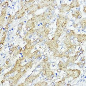 Immunohistochemistry analysis of paraffin-embedded human liver cancer using Anti-SOCS6 Antibody (A12430) at a dilution of 1:100 (40x lens)