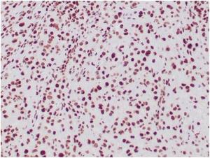 Immunohistochemical analysis of formalin-fixed, paraffin-embedded human epithelioid sarcoma tissue using Anti-SNF5 Antibody [SMARCB1/3984]