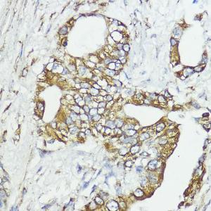 Immunohistochemistry analysis of paraffin-embedded human lung cancer using Anti-SOCS6 Antibody (A12430) at a dilution of 1:100 (40x lens)