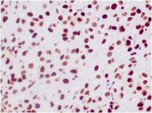 Immunohistochemical analysis of formalin-fixed, paraffin-embedded human epithelioid sarcoma tissue using Anti-SNF5 Antibody [SMARCB1/3984]