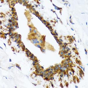 Immunohistochemistry analysis of paraffin-embedded human breast tissue using Anti-RAIDD Antibody [ARC1771] (A305654) at a dilution of 1:100 (40X lens). Perform microwave antigen retrieval with 10 mM Tris/EDTA buffer pH 9.0 before commencing with IHC staining protocol