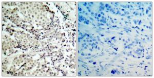 Immunohistochemical analysis of paraffin-embedded human breast carcinoma tissue using Anti-MKK6 Antibody. The right hand panel represents a negative control, where the Antibody was pre-incubated with the immunising peptide