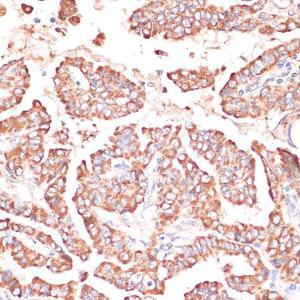 Immunohistochemistry analysis of paraffin-embedded human thyroid cancer using Anti-FRMD6/Willin Antibody (A12445) at a dilution of 1:100 (40x lens) Perform microwave antigen retrieval with 10 mM PBS buffer pH 72 before commencing with IHC staining protocol