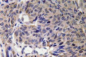 Immunohistochemical analysis of paraffin-embedded human lung carcinoma tissue using Anti-Mfn2 Antibody