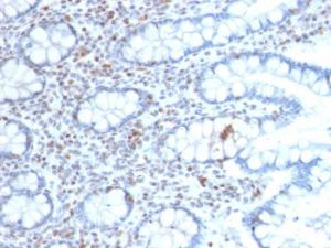 Immunohistochemical analysis of formalin-fixed, paraffin-embedded human colon carcinoma using Anti-BMI1 Antibody [BMI1/2689]