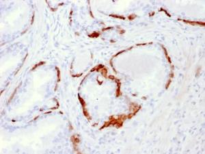 Immunohistochemical analysis of formalin-fixed, paraffin-embedded human prostate carcinoma using Anti-Cytokeratin 14 Antibody [LL002]