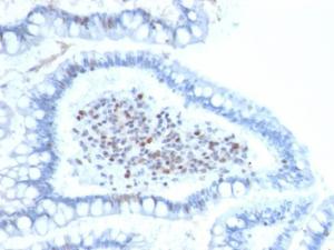 Immunohistochemical analysis of formalin-fixed, paraffin-embedded human colon carcinoma using Anti-BMI1 Antibody [BMI1/2689]