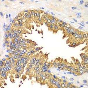 Immunohistochemistry analysis of paraffin-embedded human prostate using Anti-RIG-I / DDX58 Antibody (A309664) at a dilution of 1:100 (40x lens). Perform microwave antigen retrieval with 10 mM PBS buffer pH 7.2 before commencing with IHC staining protocol