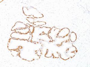 Immunohistochemical analysis of formalin-fixed, paraffin-embedded human prostate carcinoma using Anti-Cytokeratin 14 Antibody [SPM263]