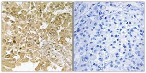 Immunohistochemical analysis of paraffin-embedded human breast carcinoma tissue using Anti-MEK1 Antibody. The right hand panel represents a negative control, where the Antibody was pre-incubated with the immunising peptide