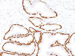 Immunohistochemical analysis of formalin-fixed, paraffin-embedded human prostate carcinoma using Anti-Cytokeratin 14 Antibody [SPM263]