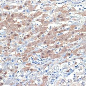 Immunohistochemistry analysis of paraffin-embedded human liver cancer using Anti-Smad4 Antibody [ARC5009-06] (A308139) at a dilution of 1:100 (40x lens)