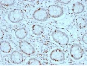 Immunohistochemical analysis of formalin-fixed, paraffin-embedded human colon carcinoma tissue using Anti-SOX4 Antibody [PCRP-SOX4-1D6]