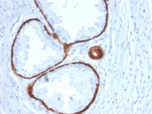 Immunohistochemical analysis of formalin-fixed, paraffin-embedded human prostate carcinoma using Anti-Cytokeratin 14 Antibody [KRT14/2375]