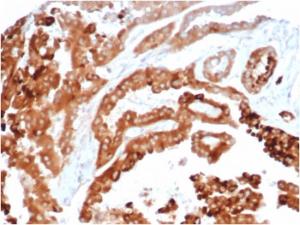 Immunohistochemical analysis of formalin-fixed, paraffin-embedded human renal carcinoma tissue using Anti-TIM3 Antibody [TIM3/4024]