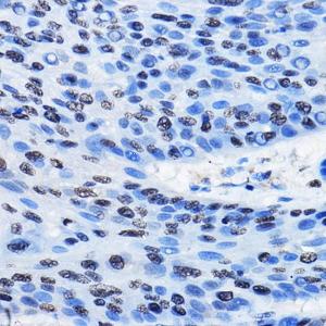 Immunohistochemistry analysis of paraffin-embedded human esophageal cancer using Anti-HP1 gamma / CBX3 (methyl His175) Antibody (A307038) at a dilution of 1:50 (40x lens). Perform high pressure antigen retrieval with 10 mM citrate buffer pH 6.0 before commencing with IHC staining protocol.