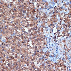 Immunohistochemistry analysis of paraffin-embedded human thyroid cancer using Anti-PKC delta Antibody [ARC1434] (A308143) at a dilution of 1:100 (40x lens). Perform microwave antigen retrieval with 10 mM Tris/EDTA buffer pH 9.0 before commencing with IHC staining protocol.