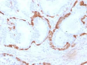 Immunohistochemical analysis of formalin-fixed, paraffin-embedded human prostate carcinoma using Anti-Cytokeratin 14 Antibody [KRT14/2375]