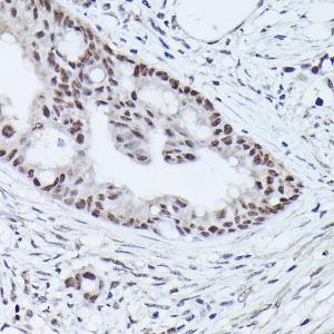 Immunohistochemistry analysis of paraffin-embedded human colon carcinoma tissue using Anti-WDR46 Antibody (A305665) at a dilution of 1:100 (40x lens)