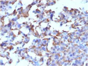 Immunohistochemical analysis of formalin-fixed, paraffin-embedded human histiocytoma using Anti-CD163 Antibody [M130/2162]