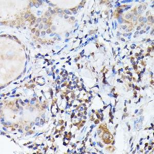 Immunohistochemistry analysis of paraffin-embedded human thyroid cancer using Anti-Bcl-2 Antibody (A308149) at a dilution of 1:100 (40X lens). Perform high pressure antigen retrieval with 10 mM citrate buffer pH 6.0 before commencing with IHC staining protocol