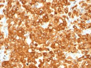 Immunohistochemical analysis of formalin-fixed, paraffin-embedded human melanoma using Anti-Melanoma gp100 Antibody [HMB45]