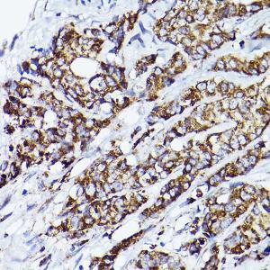 Immunohistochemistry analysis of paraffin-embedded human breast cancer tissue using Anti-VDAC2 Antibody (A307060) at a dilution of 1:100 (40x lens)