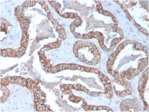 Immunohistochemical analysis of formalin-fixed, paraffin-embedded human prostate carcinoma using Anti-Cytokeratin 15 Antibody [KRT15/2957]